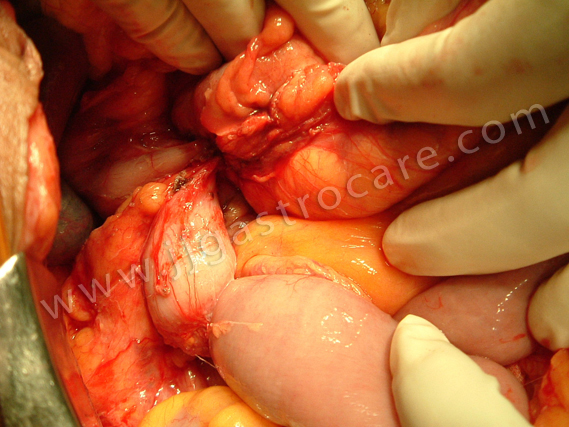 Ca Asc colon infiltrating Duodenum